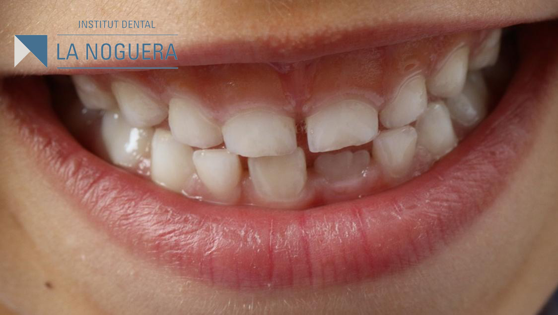 dientes de leche dents de llet