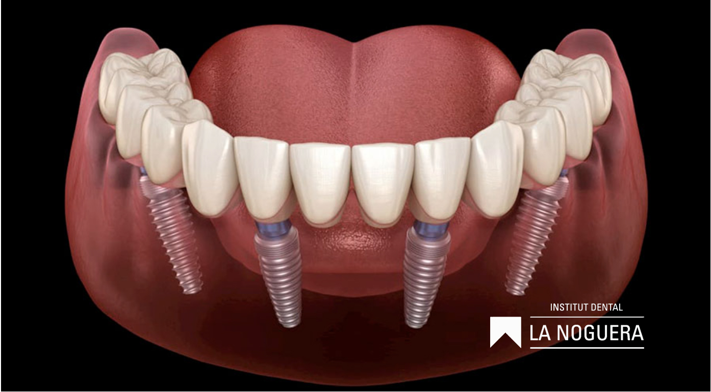 Aquesta tècnica permet la col·locació de quatre implants dentals en cada arcada, sobre els quals es fixa una pròtesi dental completa. Això proporciona una solució fixa i estable per a pacients que han perdut la majoria o la totalitat de les seves dents.