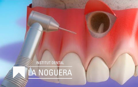 Una apicectomia (també anomenada resecció apical) és una intervenció quirúrgica que es fa quan el tractament de conductes (l’endodòncia) no ha resolt del tot una infecció al voltant de l’arrel d’una dent, i no es vol o no es pot repetir el tractament convencional.