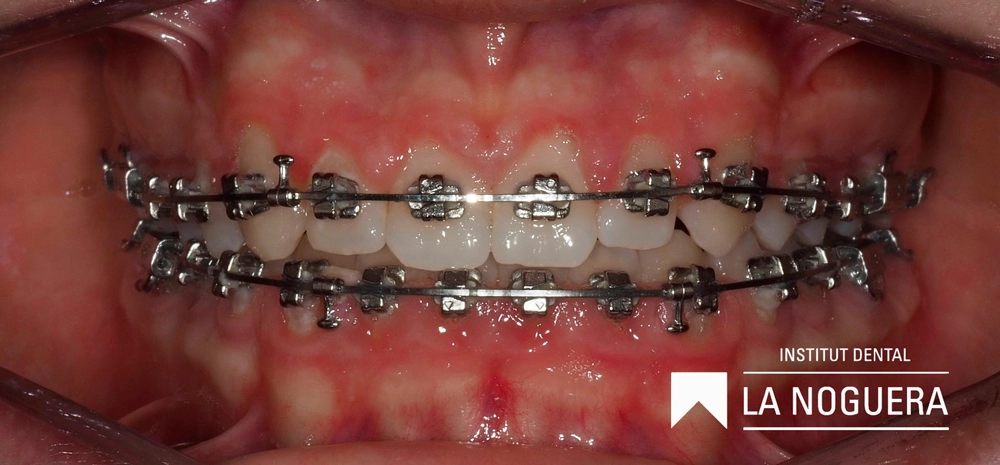 Les genives poden sagnar durant el tractament amb brackets dentals per diverses raons.