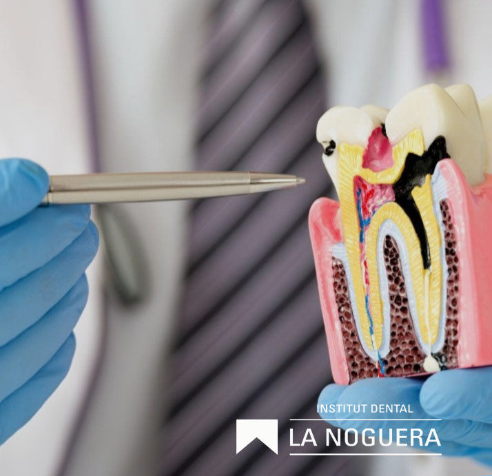 La càries (la patologia bucal més comuna) Què és? Un bacteri que transforma el sucre en àcid i “forada” la dent.